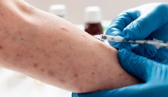 Confirman caso de sarampión en escuela pública de Puebla