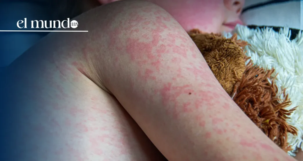 Confirman primera muerte por sarampión en la CDMX; el deceso se registró en 2025