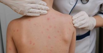 Brote de sarampión en México registra 11,062 casos confirmados