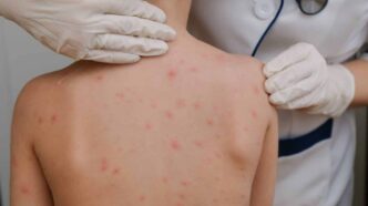 Brote de sarampión en México registra 11,062 casos confirmados