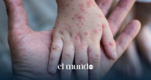 Sarampión en México 2026: casos superan los 14 mil y aumentan muertes