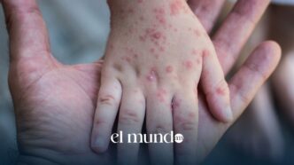 Sarampión en México 2026: casos superan los 14 mil y aumentan muertes