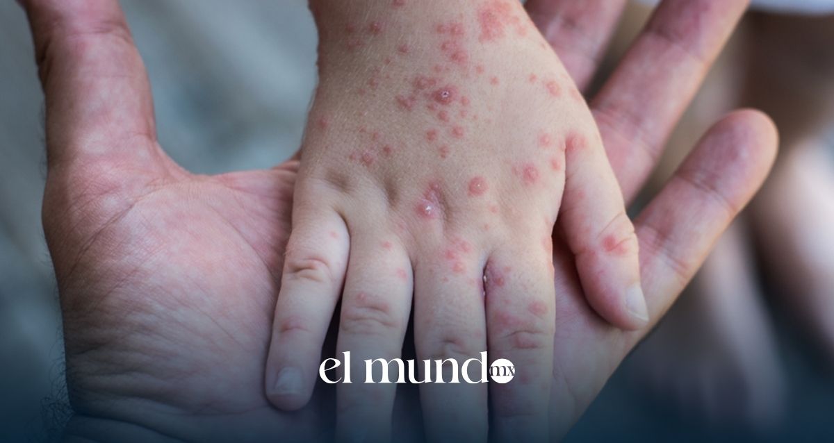 Sarampión en México 2026: casos superan los 14 mil y aumentan muertes