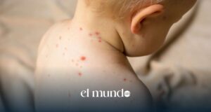 Sarampión en la CDMX: confirman segunda muerte y más de 576 casos