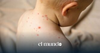 Sarampión en la CDMX: confirman segunda muerte y más de 576 casos